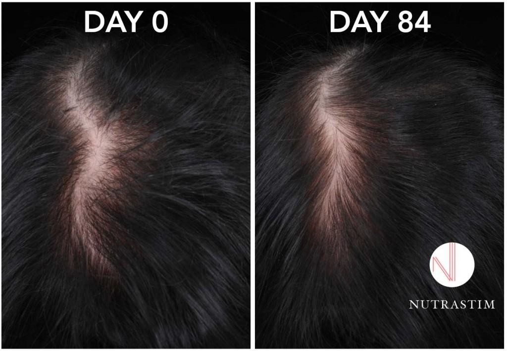 nutrastim-hair loss (2)