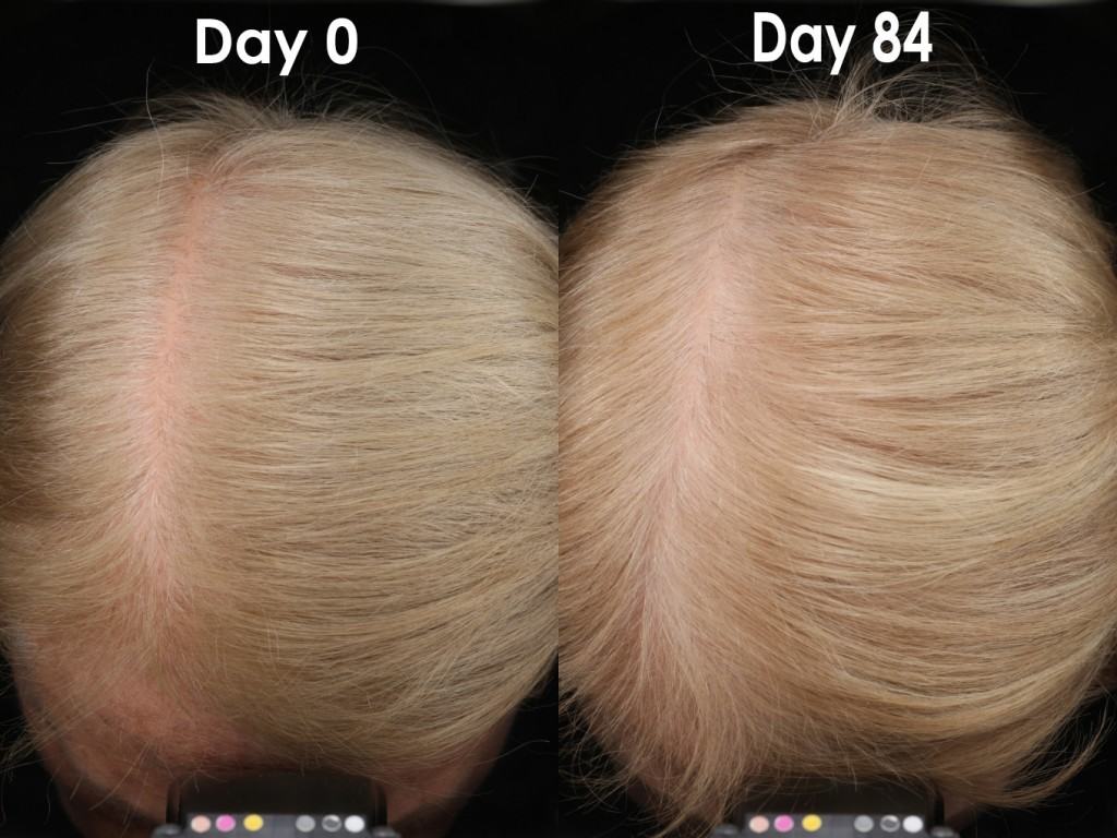 nutrastim-hair loss (3)